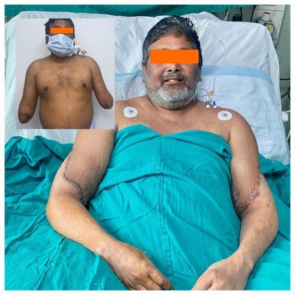 दिल्ली में हुआ पहला सफल हैंड ट्रांसप्लांट