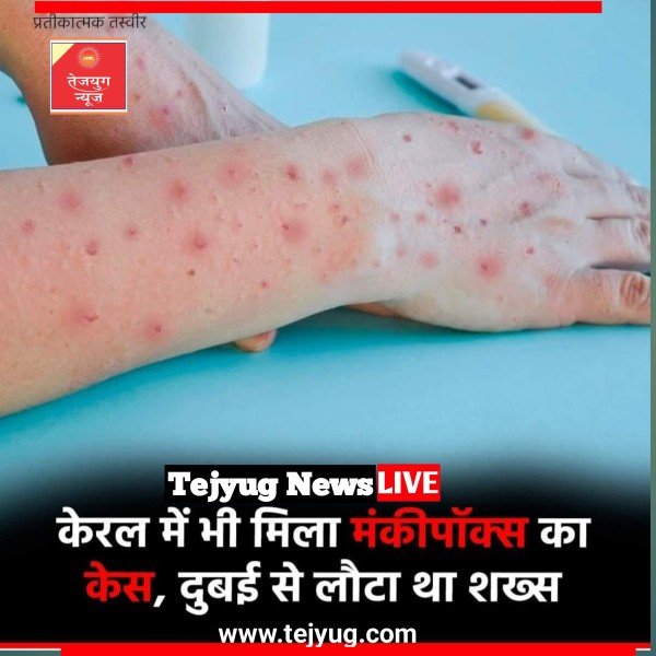 केरल के मलप्पुरम में 38 साल के एक व्यक्ति में मंकीपॉक्स