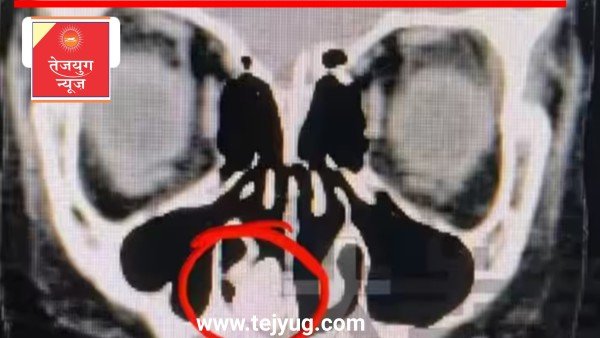 दो साल से बदबू की शिकायत कर रहे बच्चे की नाक में फंसा था कुछ ऐसा, एक्स-रे देख उड़े डॉक्टर के होश