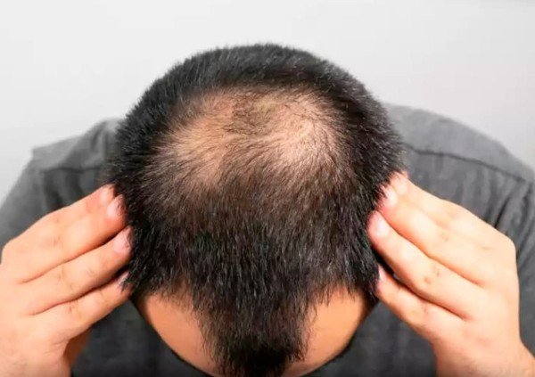 महाराष्ट्र के बुलढाणा के कई गांवों में लोग बाल झड़ने की समस्या